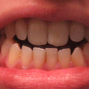 Problèmes de dents